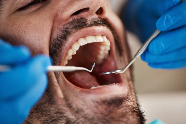 Best Emergency Wisdom Tooth Extraction in Kernersville, NC